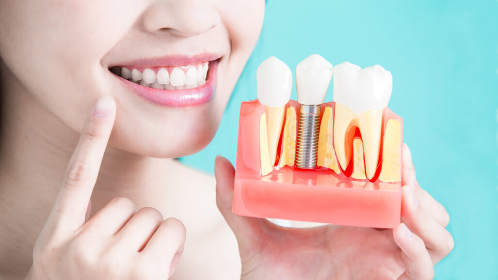 更多植体，更少付出：中国种植体集采第一季度开始破冰