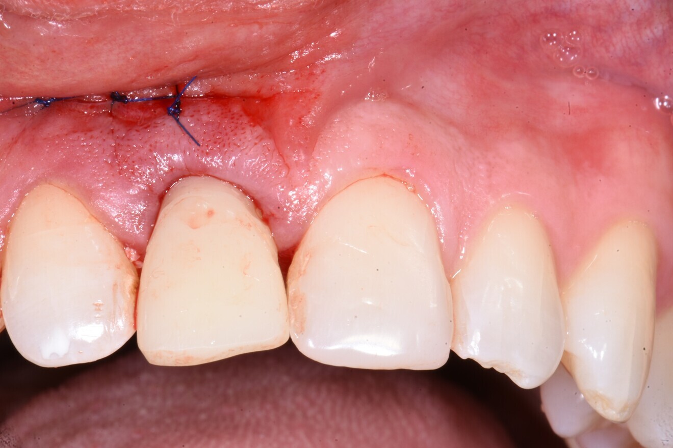 Fig. 11: Under-contoured provisional restoration placed immediately and out of occlusal contact to allow soft-tissue fill. 