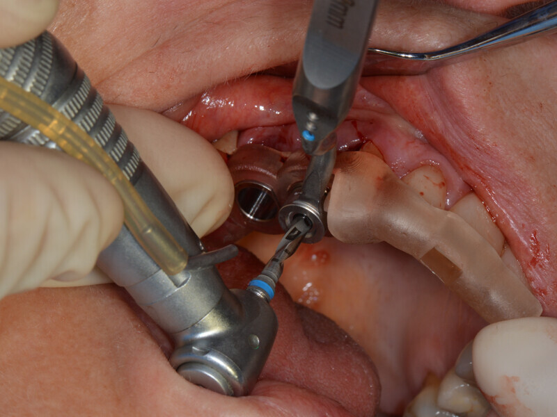 Fig. 9: Fully guided preparation being performed in accordance with the drilling protocol.