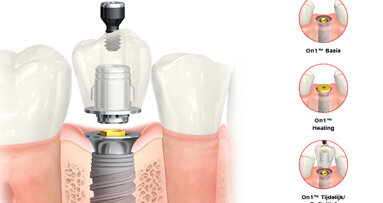 On1™-concept: combineert het beste van twee werelden