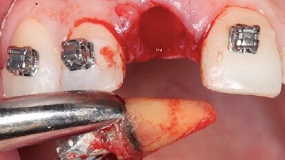 Cómo lograr cirugías exitosas y evitar complicaciones