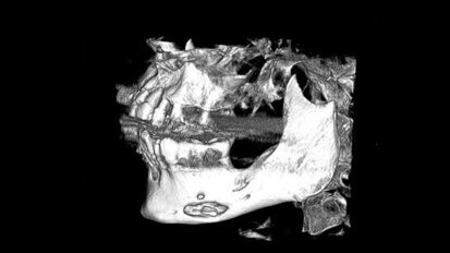 CBCT w diagnostyce i planowaniu leczenia nieswoistego przewlekłego zapalenia żuchwy – opis przypadku