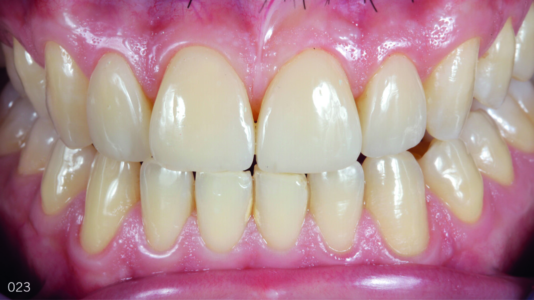 Fig. 22: Teeth in protrusion one year after the treatment, frontal view.