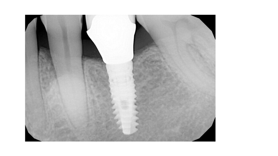 Fig. 5: Implant crown after placement.