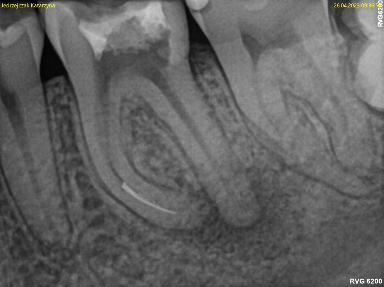 Fig. 1: Pre-op radiograph. Periapical lesion and broken file visible.