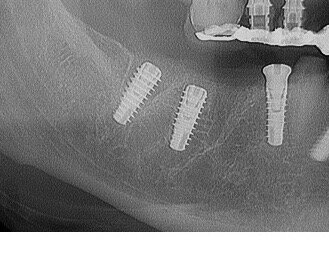 Fig. 14 - Controllo rx Post-chirurgico time 0: Si valuta bene la posizione intra-alveolare degli Impianti Multysytem.