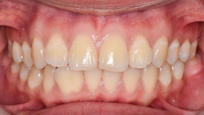 Study reveals bacteria’s competitive nature