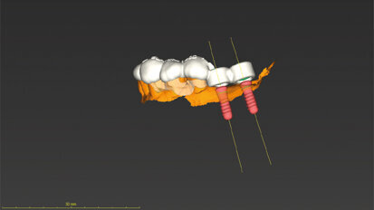 Digitalizace vaší implantologické praxe