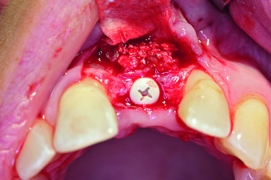 Fig. 6a: Transversal bone augmentation was performed.