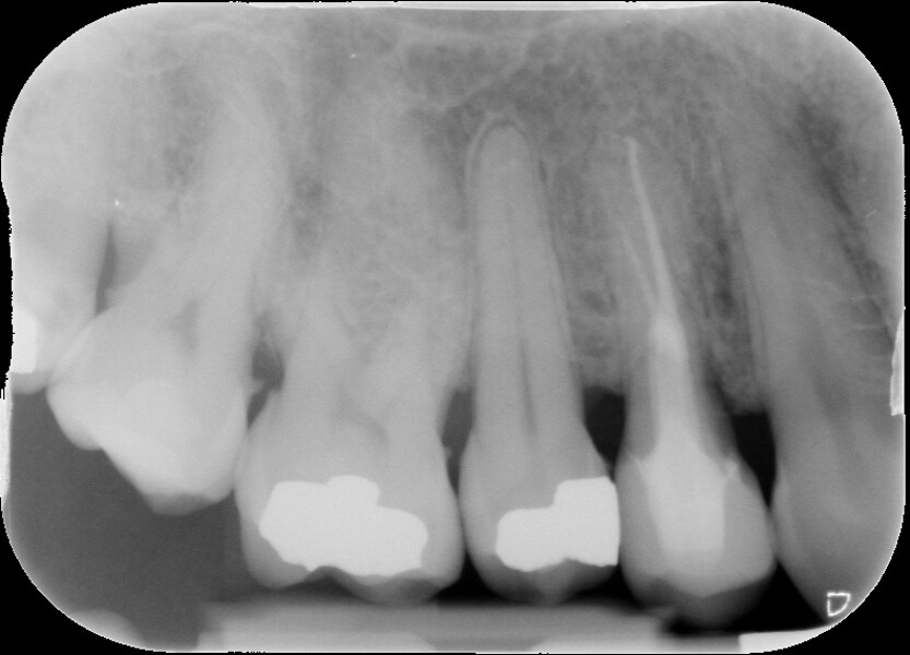 Fig. 9 : Radiographie de suivi après cinq ans.