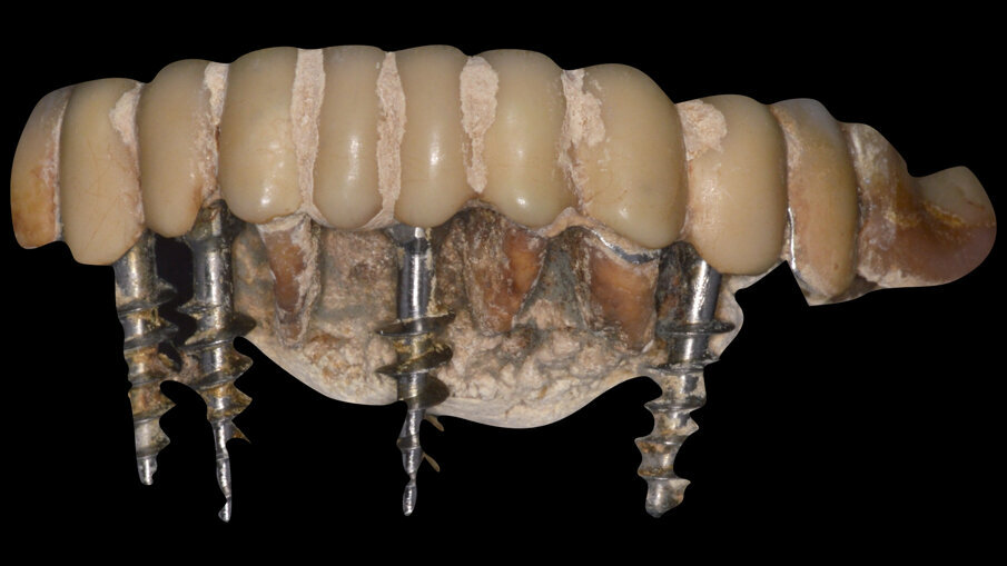 Fig. 3_Paziente con protesi a supporto implantare e dentatura naturale con scarsissima igiene orale.