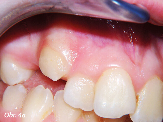 Gingivoplastika kvůli optimálnímu umístění zámku.