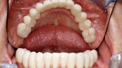 Natychmiastowa implantacja i zaopatrzenie protetyczne pacjentów z zaawansowaną chorobą przyzębia