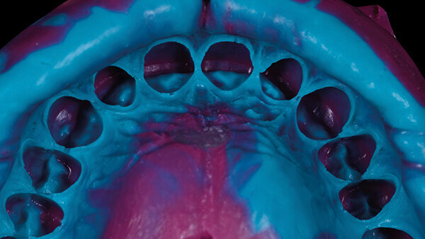 Fig. 10. Impresión analógica con polivinilsiloxano.