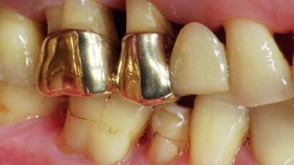 Open-healing approach to avoid flap mobilization and subsequent morbidity Open-healing approach to avoid flap mobilization and subsequent morbidity