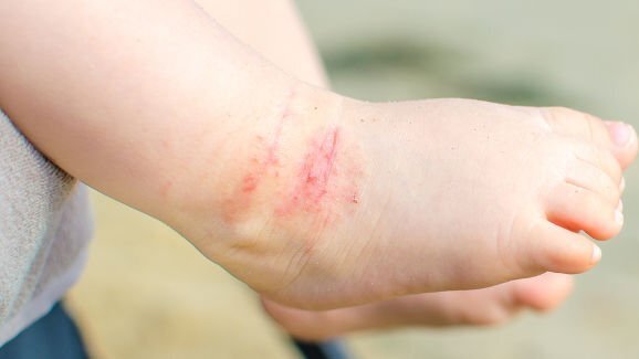 Crianças com dermatite atópica têm maior risco de cárie mais tarde na vida