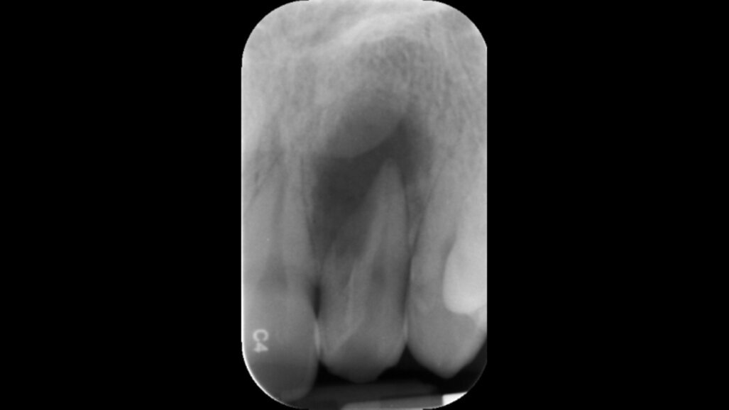 OMD promove curso de Controlo microbiológico em endodontia