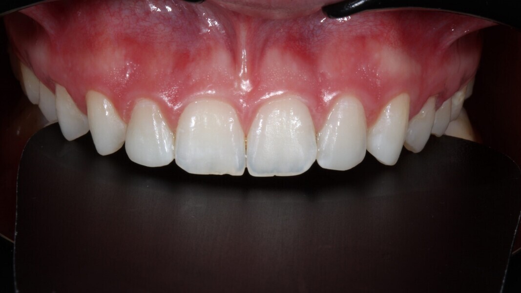 Fig. 15: Eindresultaat na afwerking en polijsten met 3M Sof-Lex Afwerk- en Polijstschijfjes.