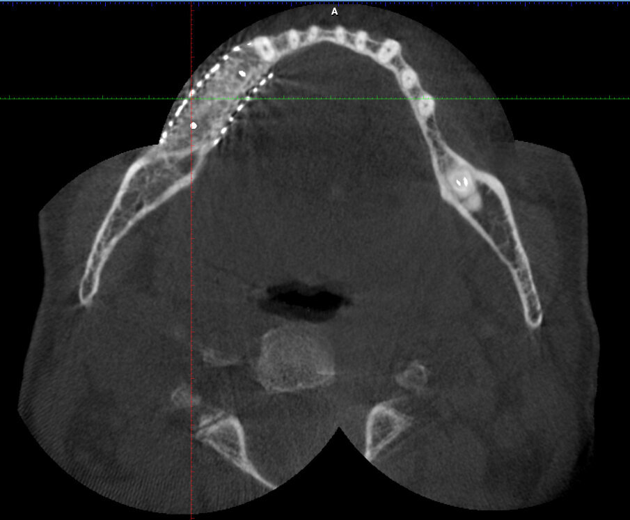 Figg. 6a, 6b_Sezioni di CBCT dopo l’intervento che mostrano l’incremento osseo ottenuto.