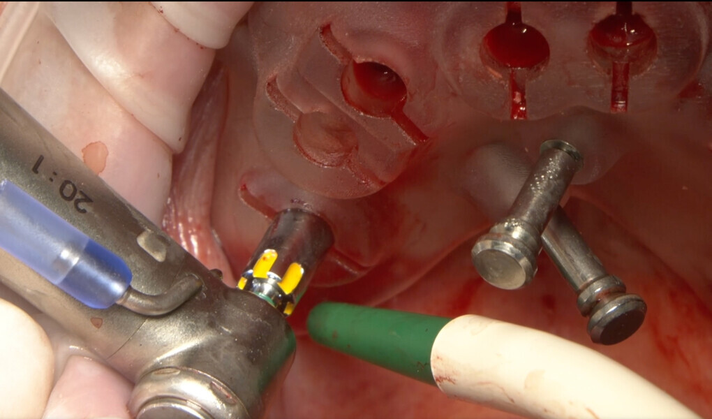 Fig. 8: Implant placement using the OneGuide KIT.
