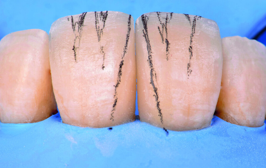 Fig 15. Marking of mesial line angle and macro anatomy
