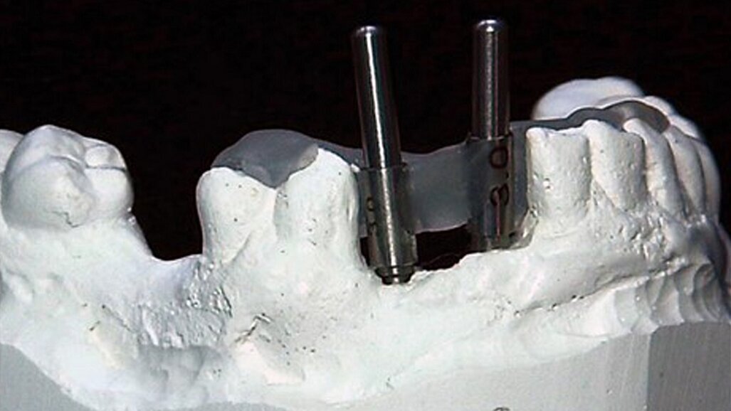 An in-office-fabricated implant surgical guide corrected using CBCT