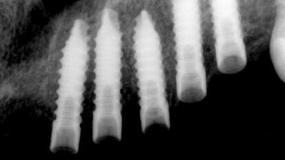 UIS Impladenta – Užití ve všech případech!