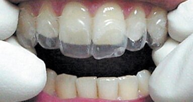 Estética y blanqueamiento dental en la era digital  (Capítulo 4)