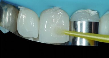 Bio-esthétique : donner un visage nouveau à l’amélioration du sourire