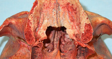 La regione palato-pterigo-tuberositaria: interesse chirurgico in implantologia