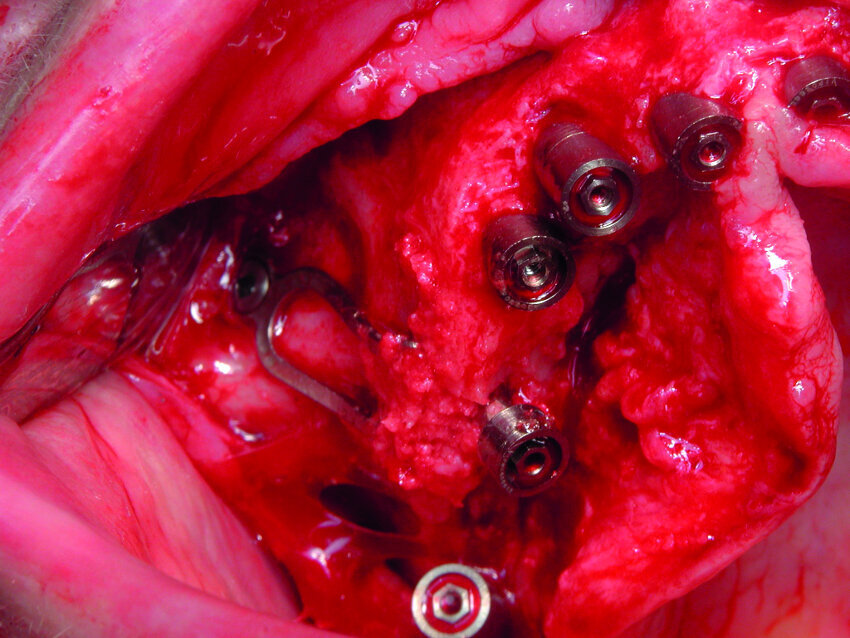 Cas 1b : Détail de l’ajustage d’un implant à plaque en vestibulaire sur le zygoma et verrouillage à l’aide de vis d’ostéosynthèses et dépôt de copeaux d’os sur la partie juxta osseuse. Nous déposerons ensuite un matériau non résorbable imbibé d’I PRF afin « d’agglomérer » les grains, puis le tout sera recouvert de membrane d’A PRF