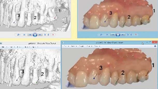 Προσωρινή αποκατάσταση με πλήρως ψηφιακή ροή