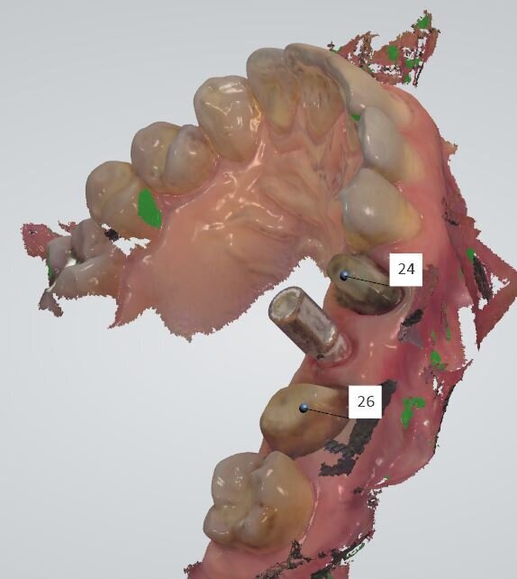 Fig. 9 - Stessa schermata con lo scan body e con la numerazione degli elementi selezionati per la realizzazione protesica definitiva.