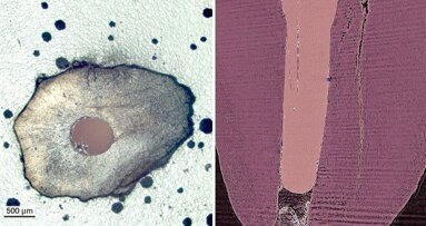 טיפולי שורש: מיקרו סדקים הם לא תוצאה של הליכים מכאניים