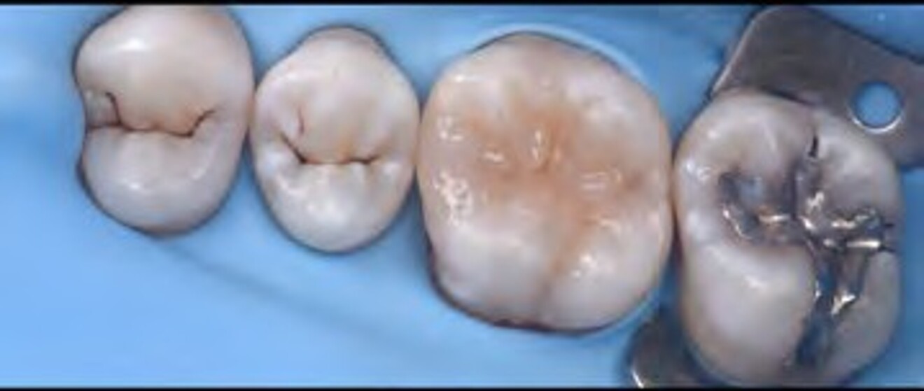  Fig. 2h: Occlusal anatomy completed with improved cusp definition and natural surface texture.