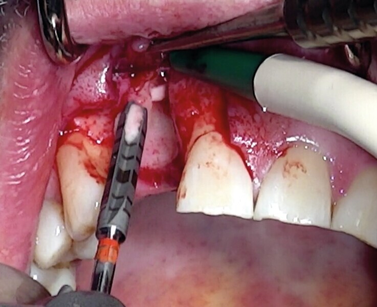 Fig. 15 : Os de forage dans les rainures des forets BLT. 