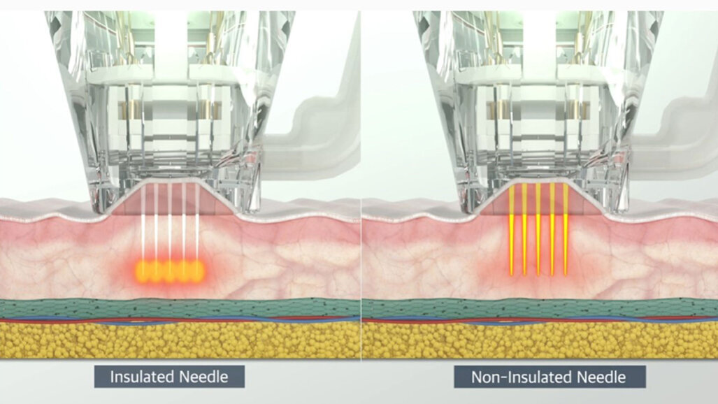 Sinergia rigenerativa in medicina estetica: RF-Needling, esosomi, peptidi  e i potenziali effetti sui telomeri