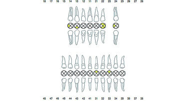 Οξεία περιοδοντίτιδα και αρνητική κλινική πορεία σε ασθενείς με κίρρωση του ήπατος.