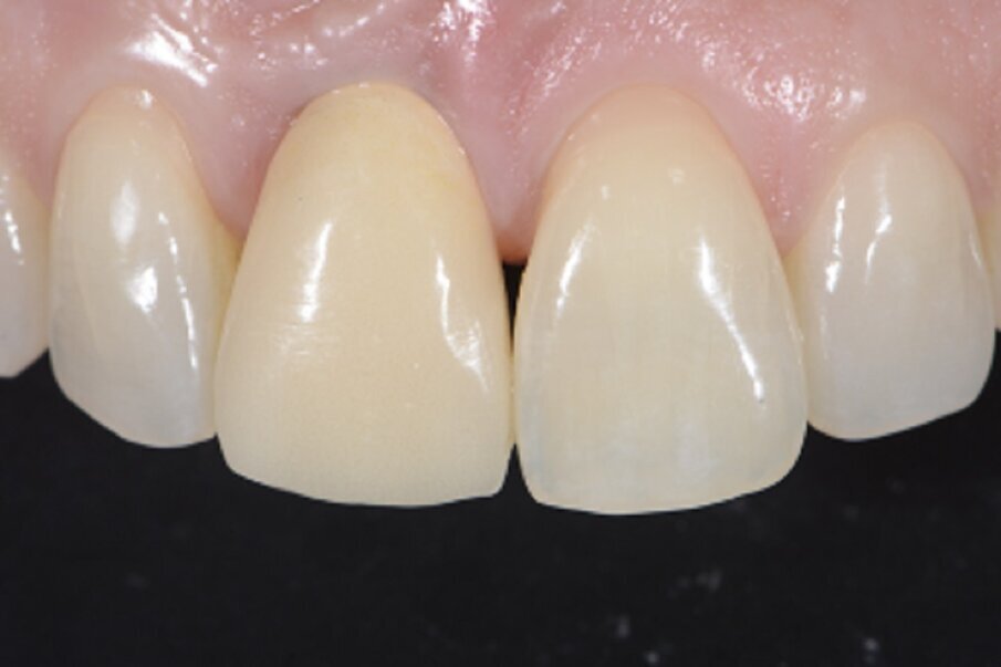 Fig. 14b: The ant erior crown restored.