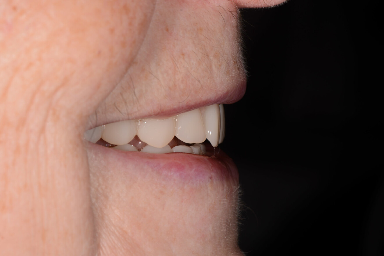 Fig. 24: Definitive complete dentures in situ, lateral view.