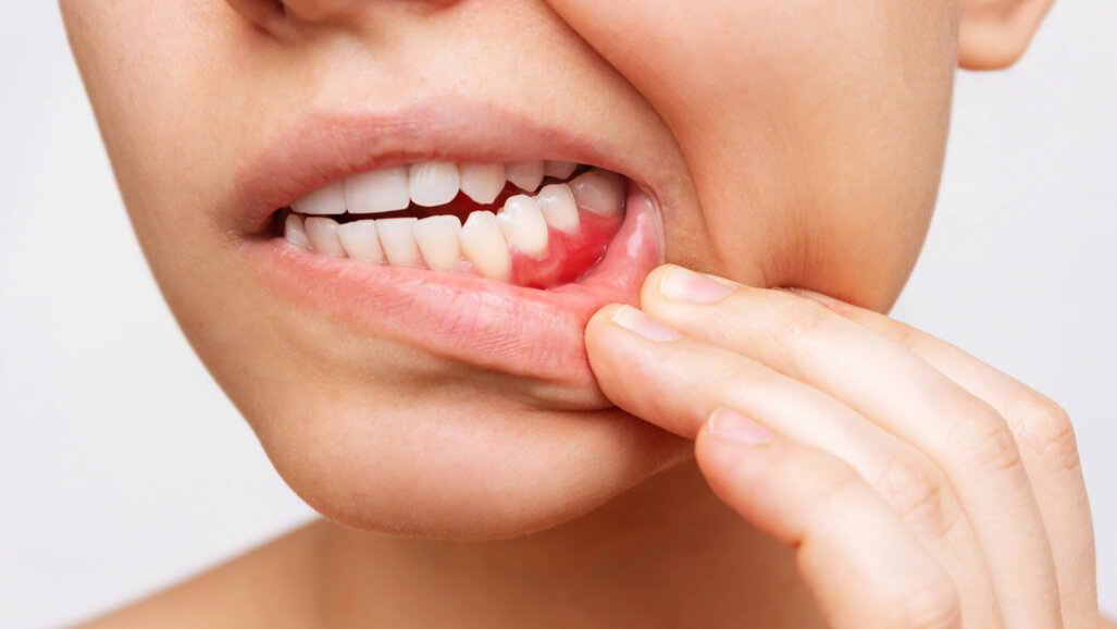 Salivary biomarkers reveal link between periodontitis and metabolic syndrome risk