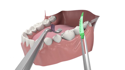 Composi-Tight® 3D Fusion™ Instructional Video