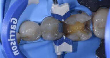 Controllo del contatto prossimale con sistema Garrison Composi-Tight 3D Fusion Sectional Matrix