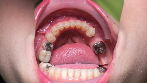 UE apoia proibição de amálgama em crianças e mulheres grávidas ou lactantes