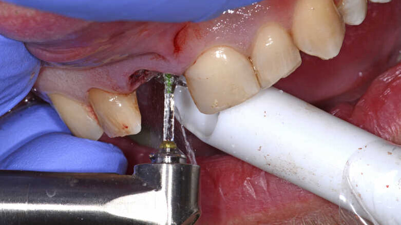 新技术及数字化种植方案在一段式手术中的应用