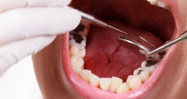 Płaskie plomby psują zgryz!