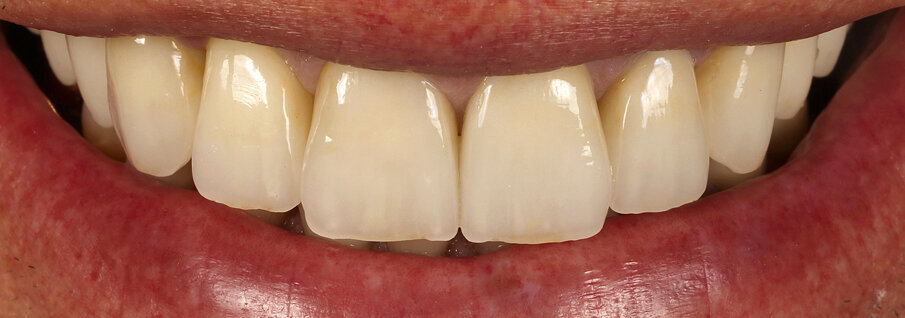 Fig. 26: The final result shows a pleasing esthetic appearance.