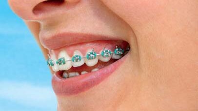 Popularne klocki pomocne w promowaniu aparatów ortodontycznych