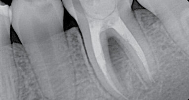 Praktické klinické faktory v reendodontické terapii