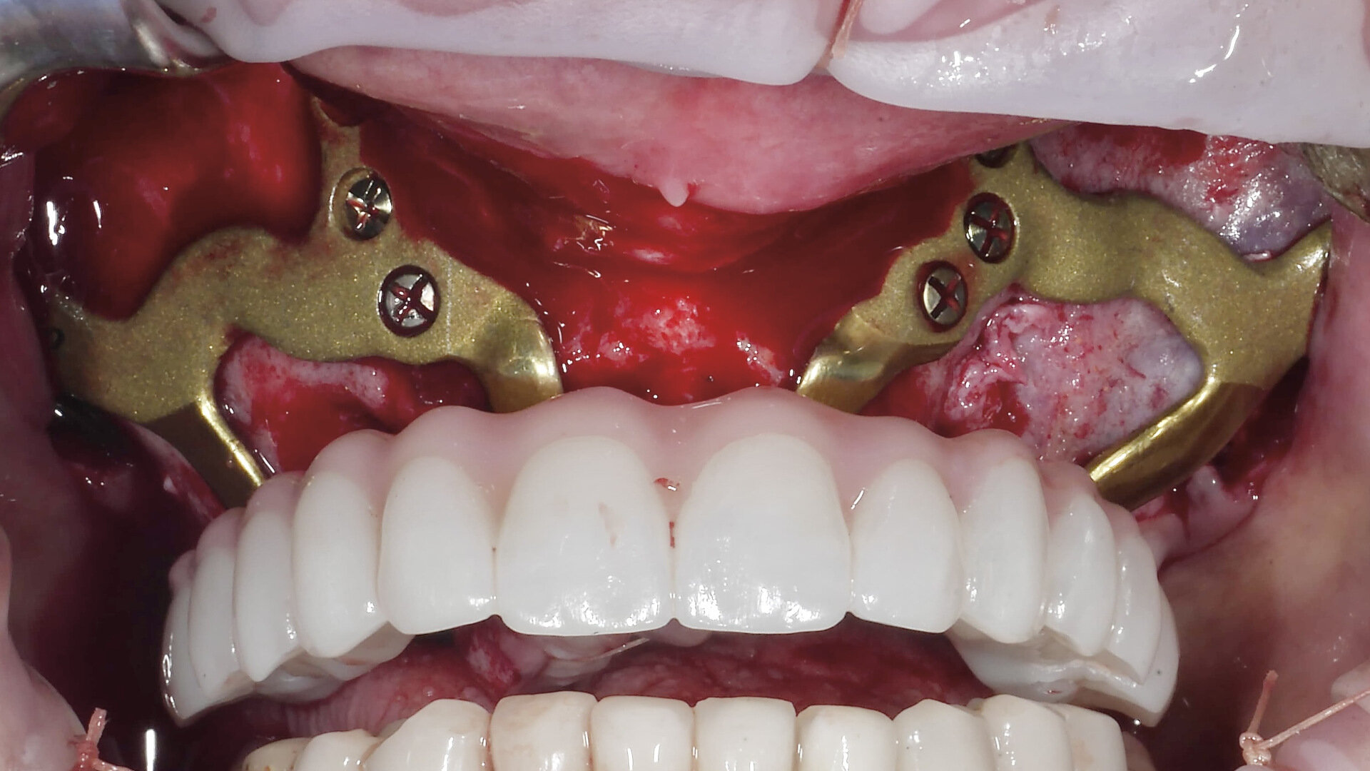 Quelle alternative à l’implantologie conventionnelle — implant zygomatique ou implant sous périosté ?